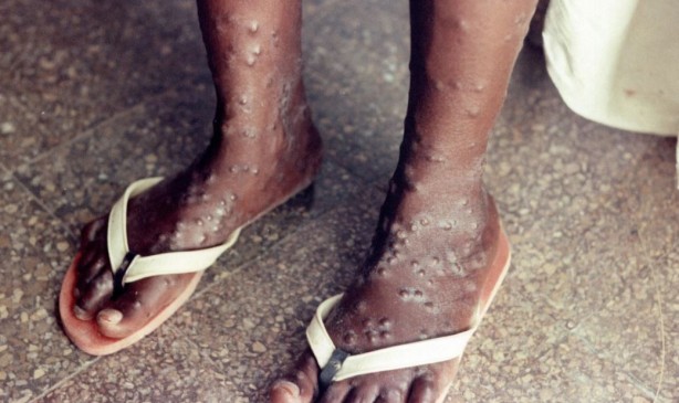 Dünya Sağlık Örgütü'nden Maymun Çiçeği açıklaması! 'Stratejik Hazırlık ve Müdahale Planı' geliştirildi