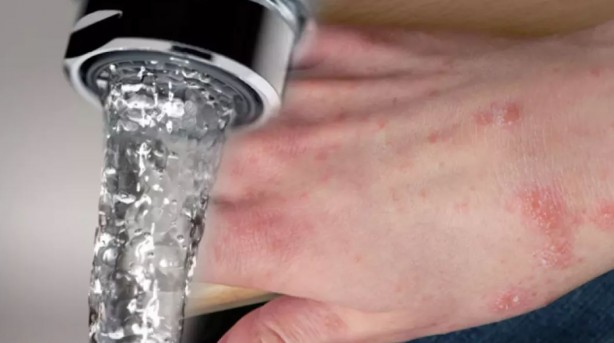 Foto - Dünyada görülen nadir ve garip 10 hastalık...