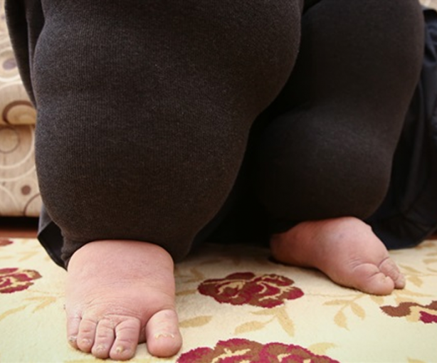 Foto - Dünyada görülen nadir ve garip 10 hastalık...