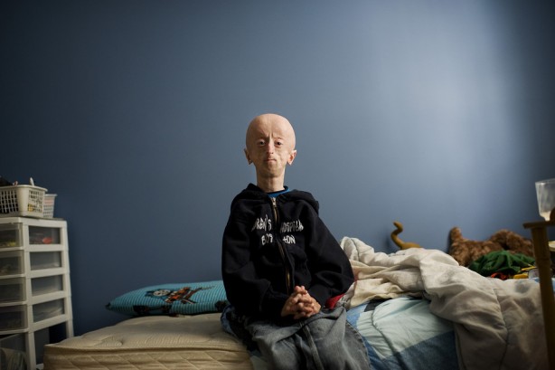 Foto - Dünyada görülen nadir ve garip 10 hastalık...