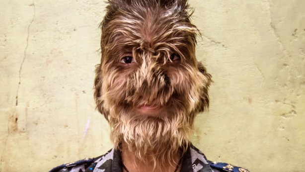 Dünyada görülen nadir ve garip 10 hastalık...