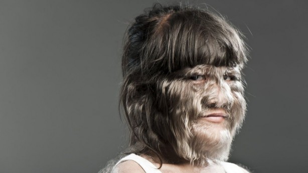 Foto - Dünyada görülen nadir ve garip 10 hastalık...