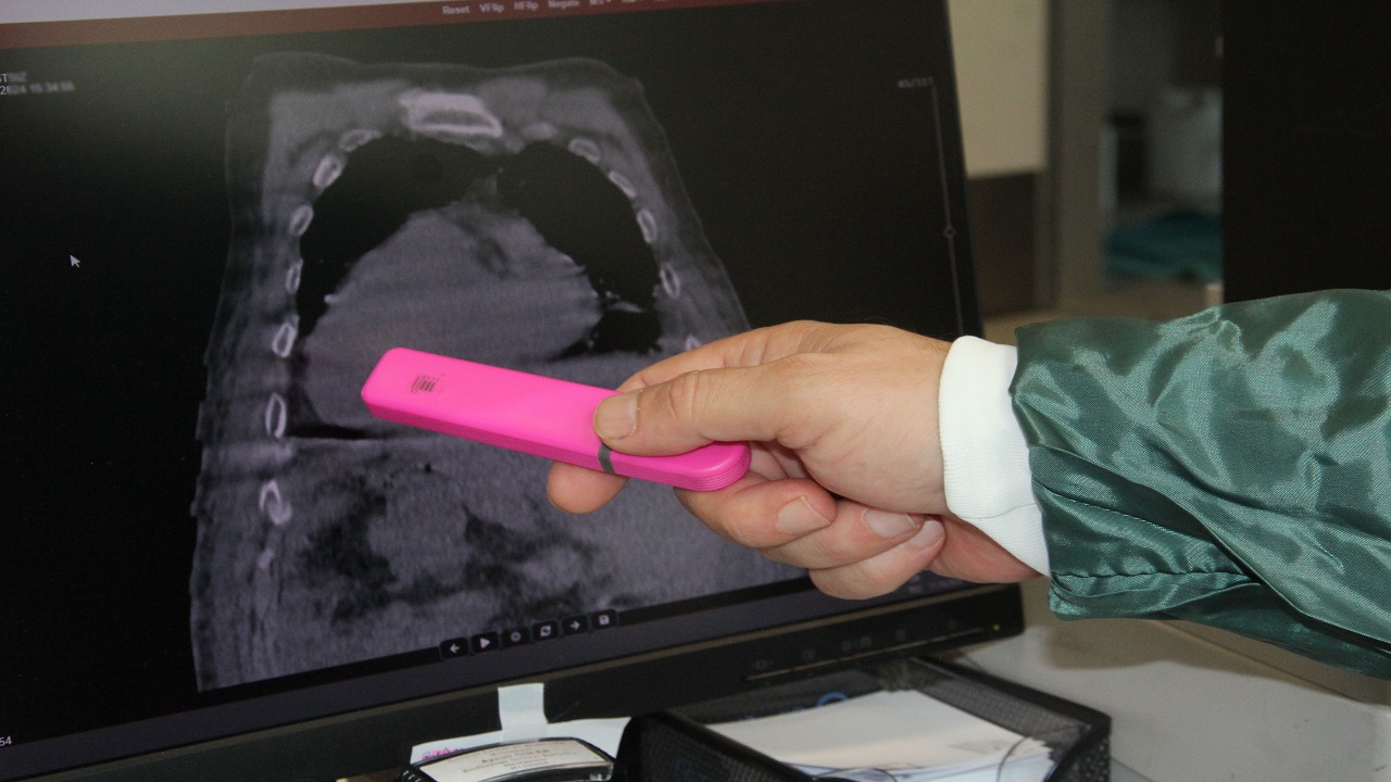 Dünyada ilk kez görüldü! "Giresun Sendromu" tıp literatürüne girdi