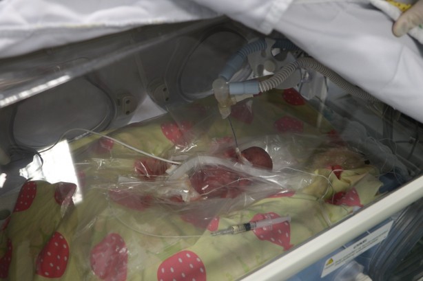 Foto - Dünyada nadir rastlanıyor! Türkiye'de 310 gramlık bebek doğdu