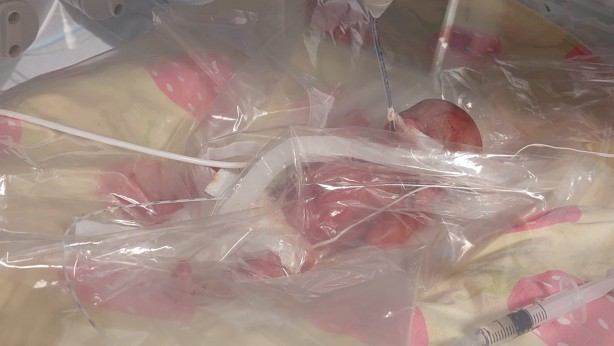 Dünyada nadir rastlanıyor! Türkiye'de 310 gramlık bebek doğdu