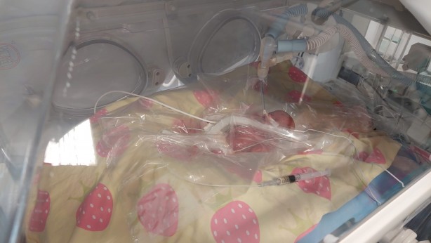 Foto - Dünyada nadir rastlanıyor! Türkiye'de 310 gramlık bebek doğdu