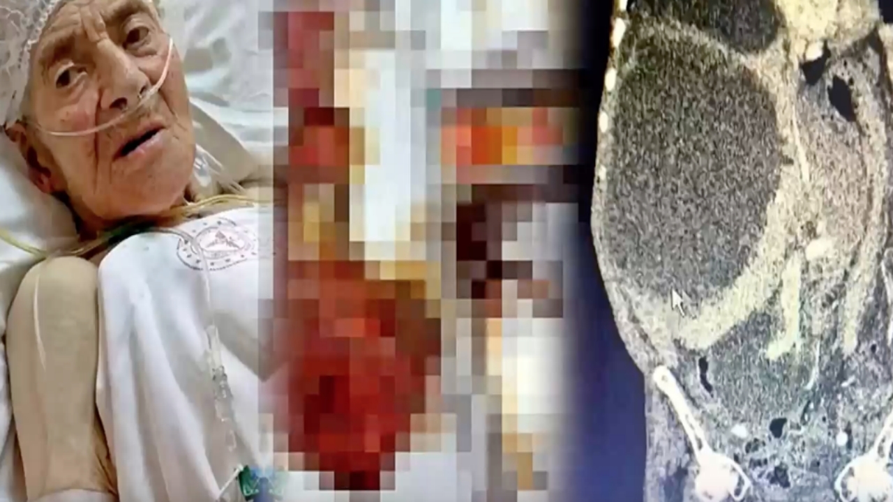 Dünyada örneği yok! Karın şişliğiyle gitti, karnından 90 santimetrelik kedi-köpek...