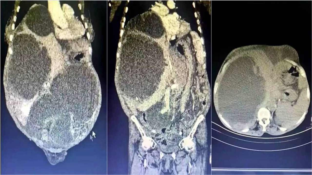 Foto - Dünyada örneği yok! Karın şişliğiyle gitti, karnından 90 santimetrelik kedi-köpek...