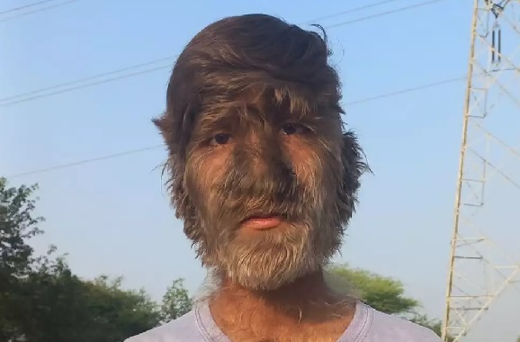 Foto - Dünyada sadece 50 kişide bu hastalık var! Kurt adamlar gerçek mi? 