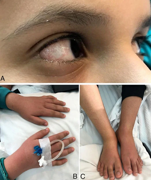 Foto - Dünyanın başındaki yeni bela! Kawasaki hastalığı nedir? Belirtileri nelerdir?