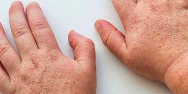 Foto - Dünyanın başındaki yeni bela! Kawasaki hastalığı nedir? Belirtileri nelerdir?