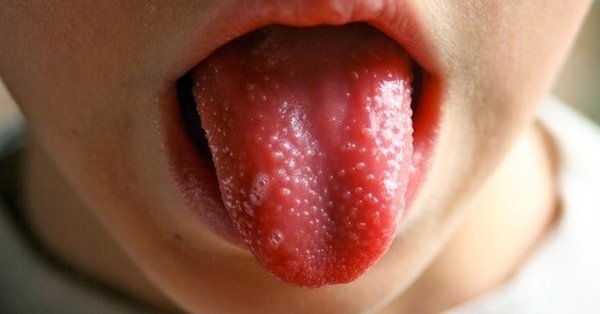 Foto - Dünyanın başındaki yeni bela! Kawasaki hastalığı nedir? Belirtileri nelerdir?