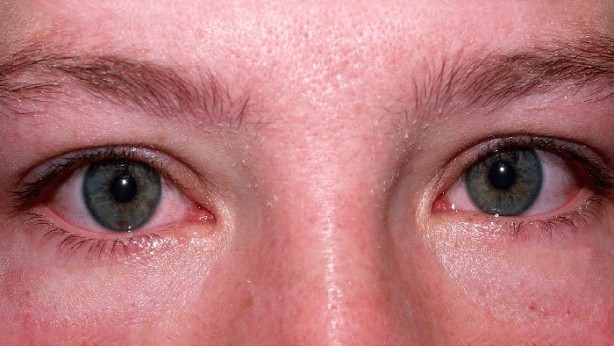 Foto - Dünyanın başındaki yeni bela! Kawasaki hastalığı nedir? Belirtileri nelerdir?