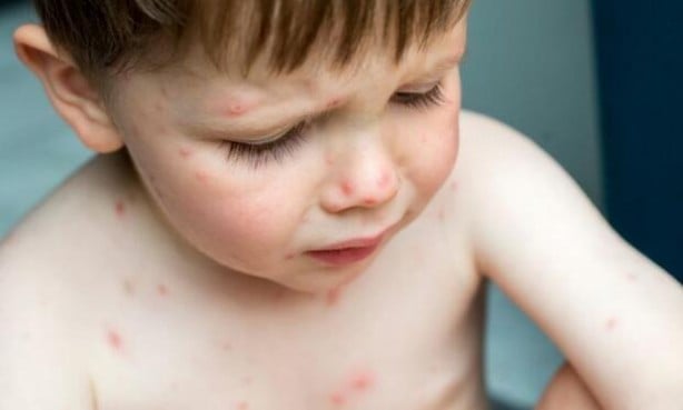 Foto - Dünyanın başındaki yeni bela! Kawasaki hastalığı nedir? Belirtileri nelerdir?