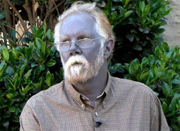 Foto - Dünyanın en ilginç hastalıkları