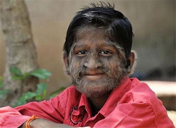 Foto - Dünyanın en ilginç hastalıkları