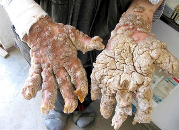 Foto - Dünyanın en ilginç hastalıkları