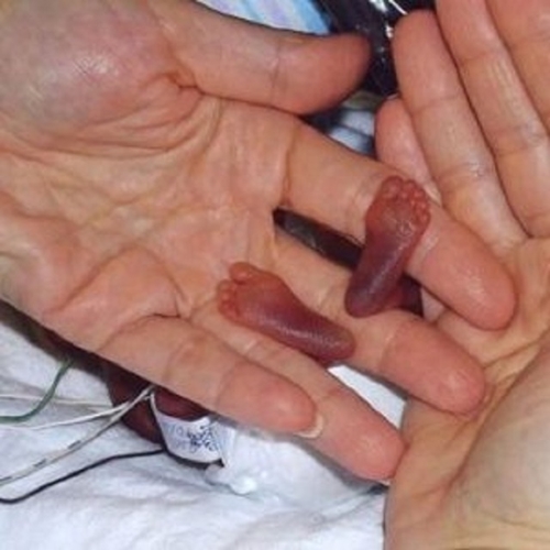 Dünyanın en küçük bebeği büyüdü! İşte son hali