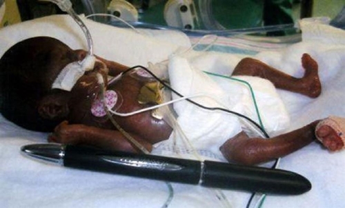 Foto - Dünyanın en küçük bebeği büyüdü! İşte son hali