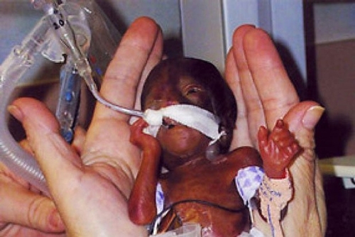 Foto - Dünyanın en küçük bebeği büyüdü! İşte son hali