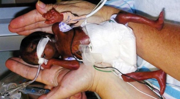 Foto - Dünyanın en küçük bebeğiydi! Son hali şaşırttı