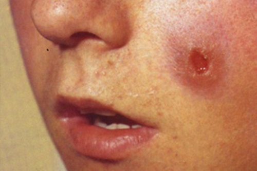 Foto - Dünyanın en tehlikeli 12 hastalığı