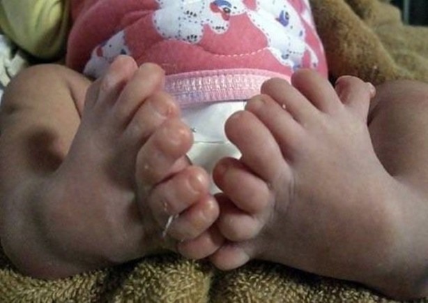 Foto - Dünyanın en tuhaf hastalıkları