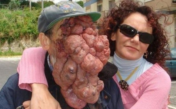 Foto - Dünyanın en tuhaf hastalıkları