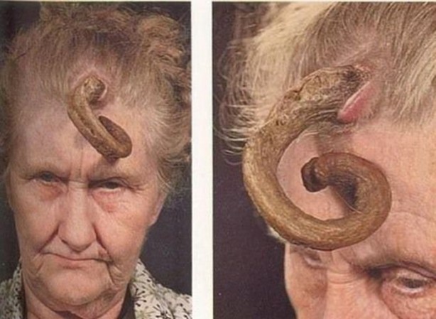 Foto - Dünyanın en tuhaf hastalıkları