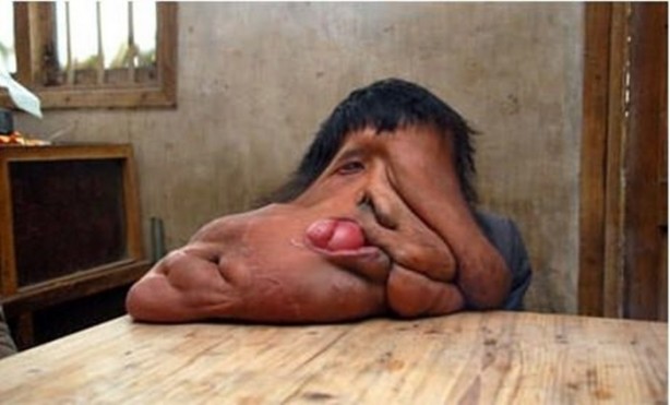 Foto - Dünyanın en tuhaf hastalıkları