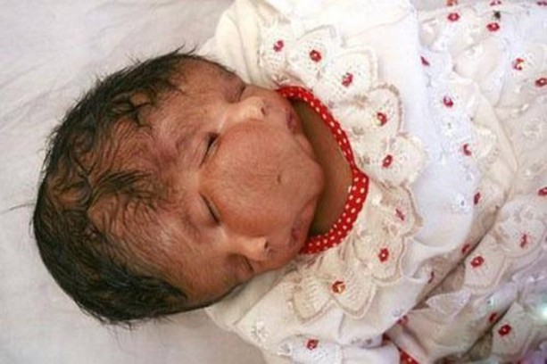 Foto - Dünyanın en tuhaf hastalıkları