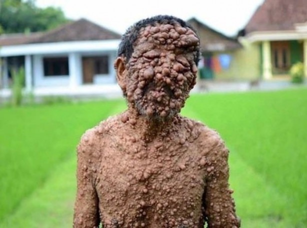 Foto - Dünyanın en tuhaf hastalıkları