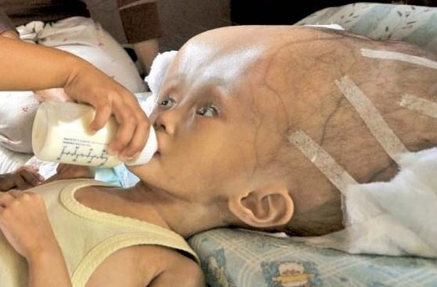 Foto - Dünyanın en tuhaf hastalıkları