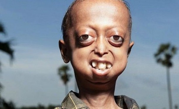 Foto - Dünyanın en tuhaf hastalıkları