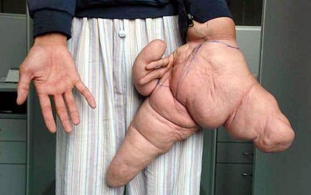 Foto - Dünyanın en tuhaf hastalıkları