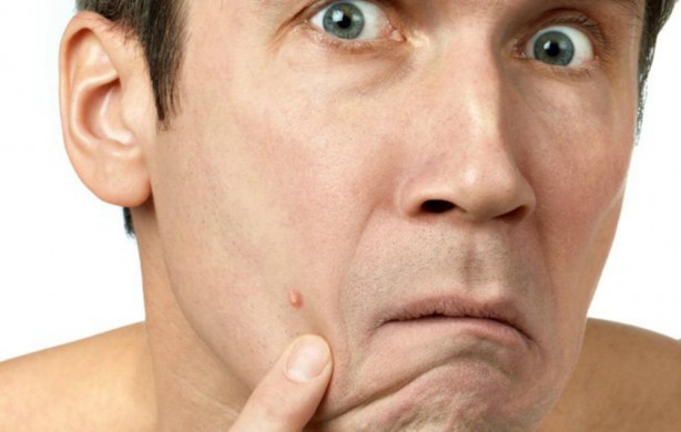 Foto - Eğer çıkan sivilce yüzünüzün bu bölgesindeyse aman dikkat! Hangi bölgede çıkıyorsa o hastalığın habercisi