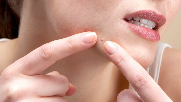 Foto - Eğer çıkan sivilce yüzünüzün bu bölgesindeyse aman dikkat! Hangi bölgede çıkıyorsa o hastalığın habercisi