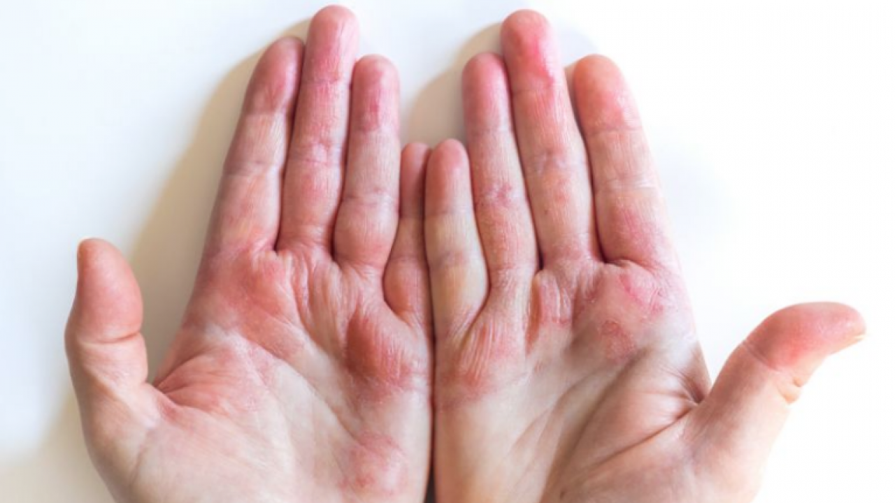 Egzamadan kurtaran en iyi doğal tedavi olacak: Çarpıcı yolu şaşırttı, görenleri hayrete düşürdü! Bakın nasıl yapılıyor