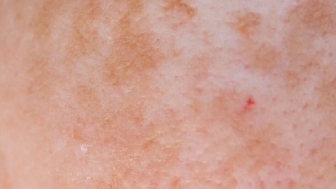 Foto - Egzaması olanların dikkatine! Bu 7 faktör tetikliyor olabilir