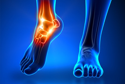 Foto - Eklem iltihabını tetikleyen besinler