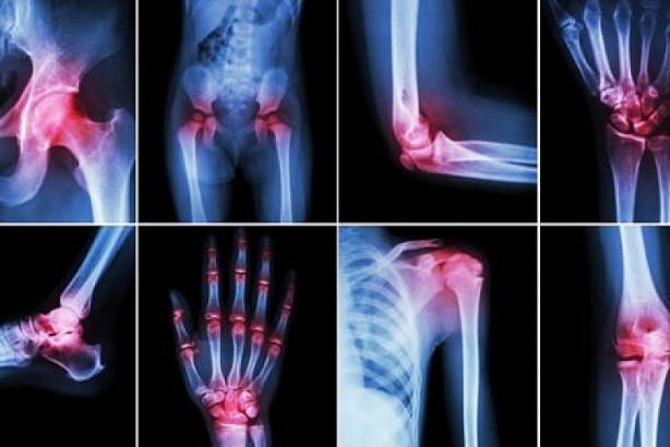 Foto - Eklem ve kemik ağrılarını bıçak gibi kesen doğal yöntem