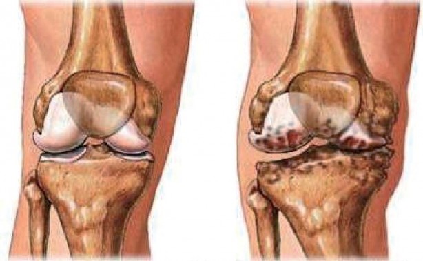 Foto - Eklem ve kemik ağrılarını bıçak gibi kesen doğal yöntem