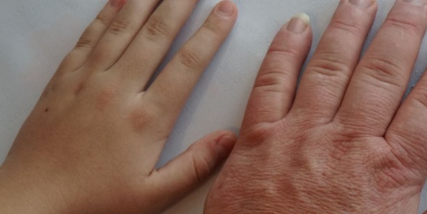 Foto - Eksikliği depresyona sürüklüyor! D vitamini eksikliği belirtileri 