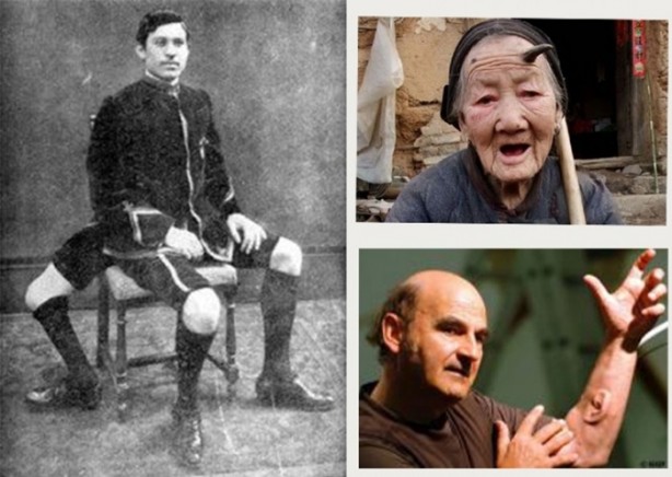 Ekstra organları olan insanlar