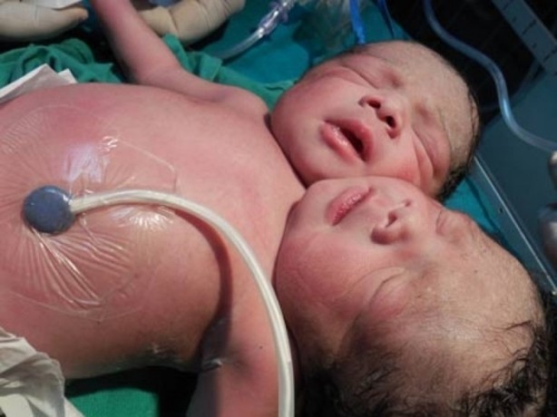 Foto - Ekstra organları olan insanlar