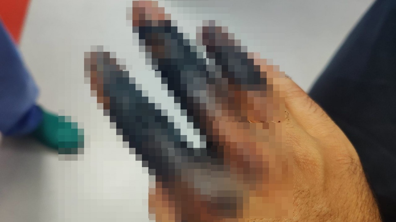 Foto - Elektrikli skuterini şarj etmek istedi, batarya elinde patladı!