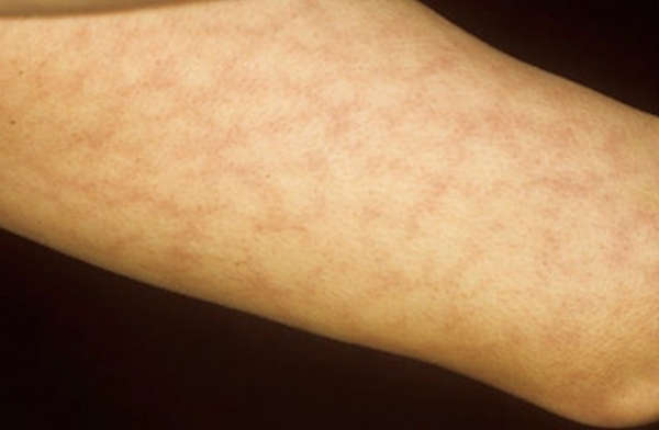 Foto - Ellerde geçmeyen uyuşma ciddi hastalıkların habercisi!