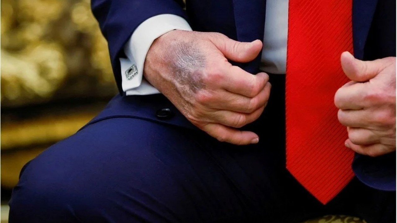 Foto - Elleri mosmor oldu... Trump ölüyor mu?