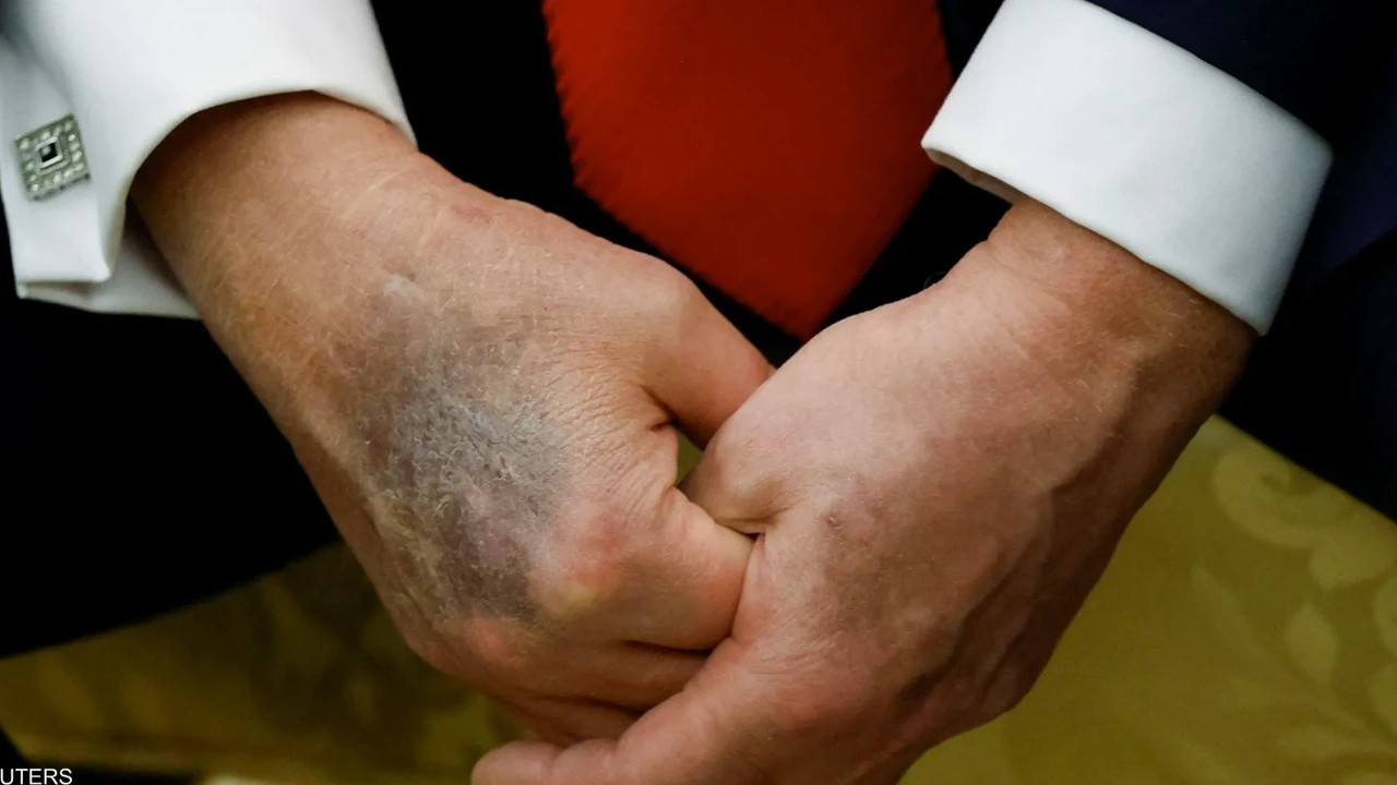 Foto - Elleri mosmor oldu... Trump ölüyor mu?