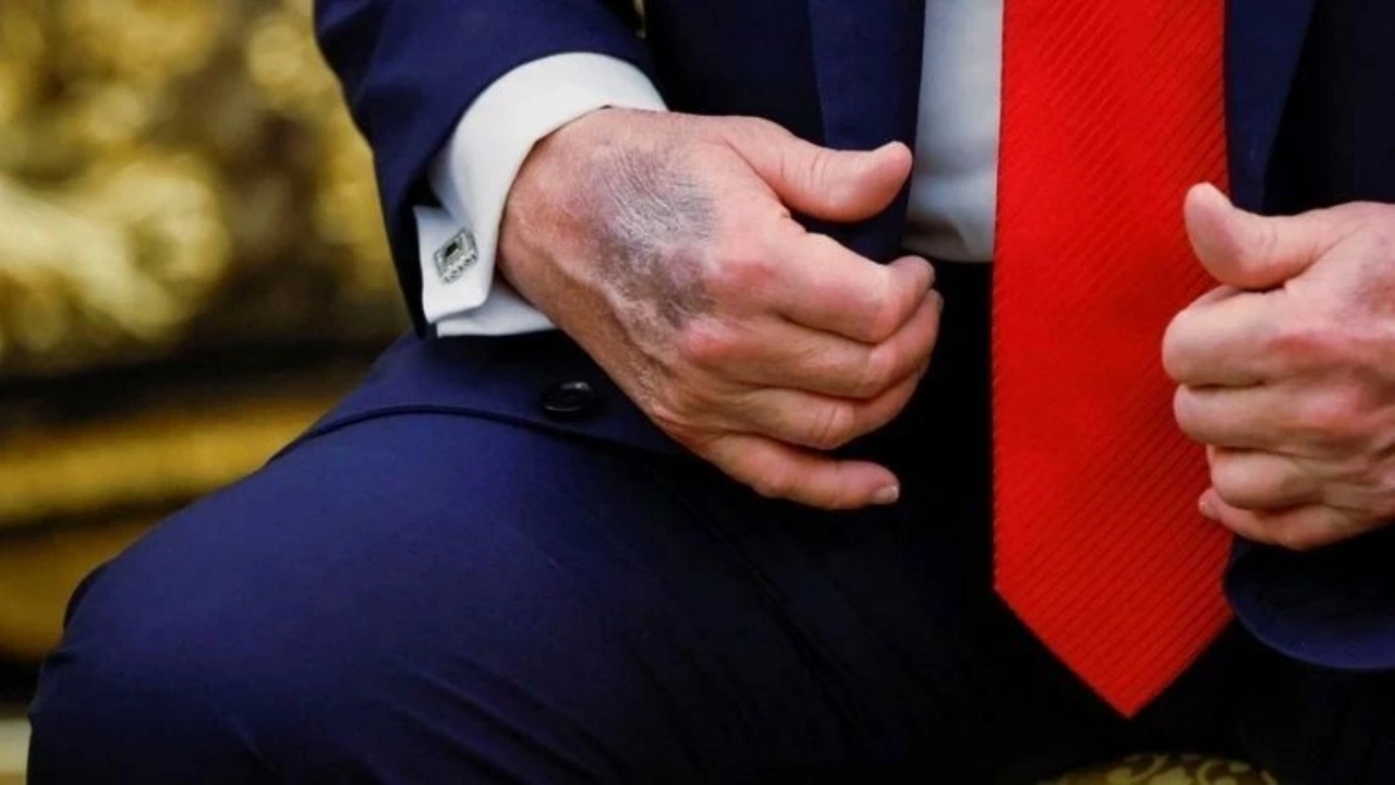 Foto - Elleri mosmor olmuştu! Günler sonra ortaya çıkan Trump’ın son hali tüm dünyayı şaşırttı